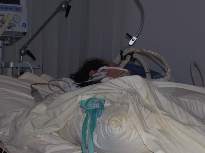 Проведение длительной ИВЛ